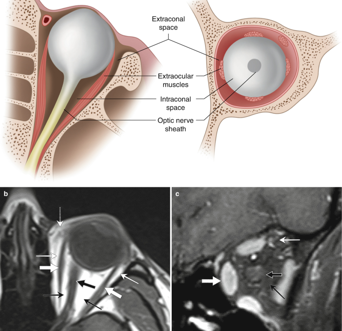 Computer Vision Syndrome Radiology symptoms and physiological triggers comparison table